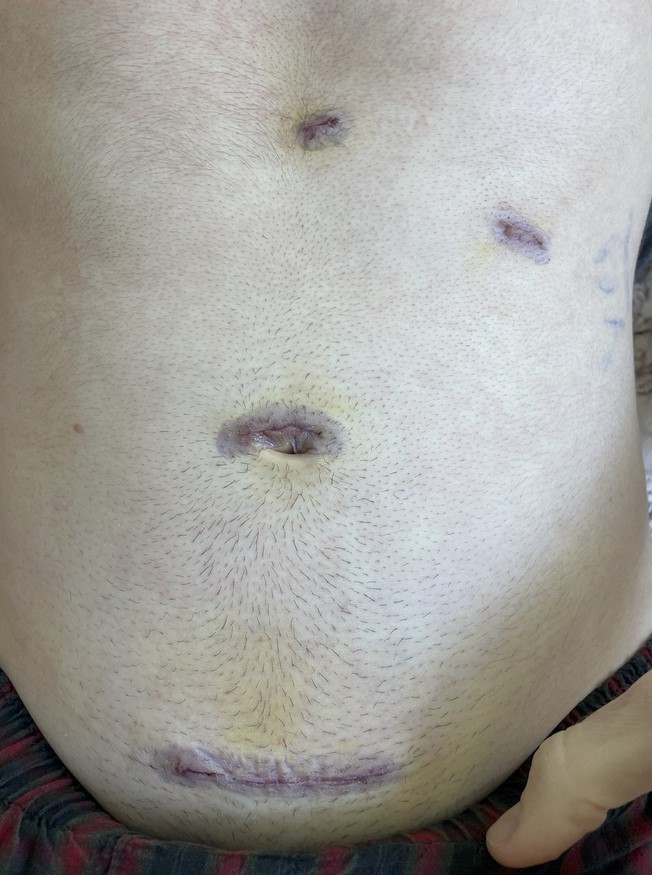 My torso with four incisions